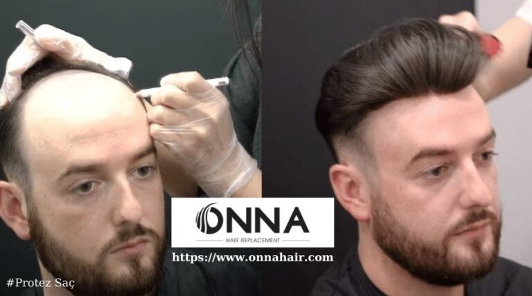 Protez Saç Kullananların Favori Saç Bakım Markaları