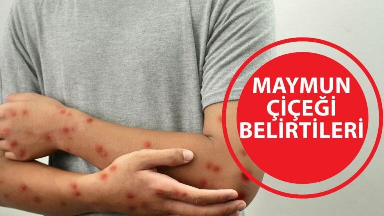 MAYMUN ÇİÇEĞİ BELİRTİLERİ: Maymun çiçeği virüsü nasıl bulaşır? Maymun çiçeği alarmı!