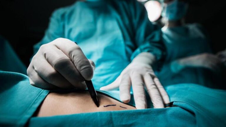Liposuction Nedir, Nasıl Yapılır? Liposakşın Tedavisi Hangi Durumlarda Uygulanır?